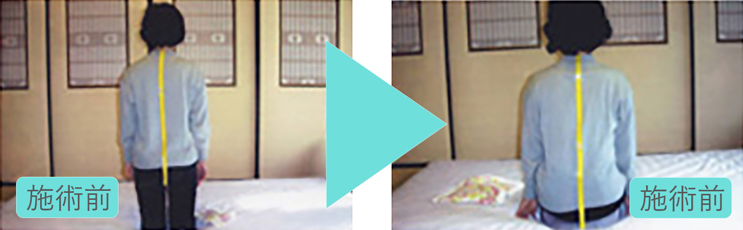 座骨神経痛 梨状筋症候群の手術とリハビリ2年 胸郭出口症候群手術予定 正座不可能